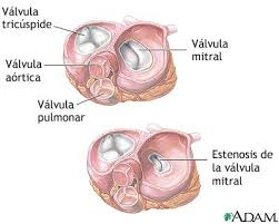 Valvulopatías