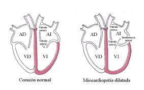 Miocardiopatías
