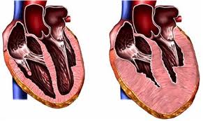 Miocardiopatías familiares