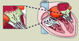 Endocarditis