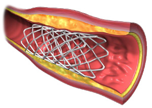 Stent Coronario