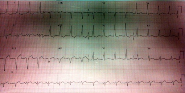 ECG