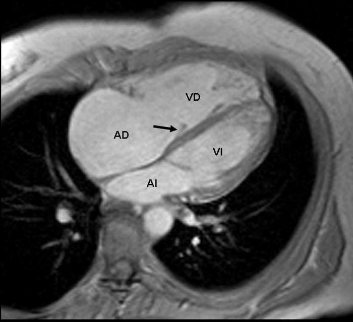 Imagen de RMN Cardiaca